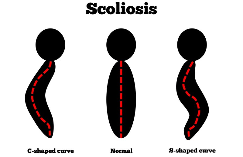 Singapore,  scoliosis treatment